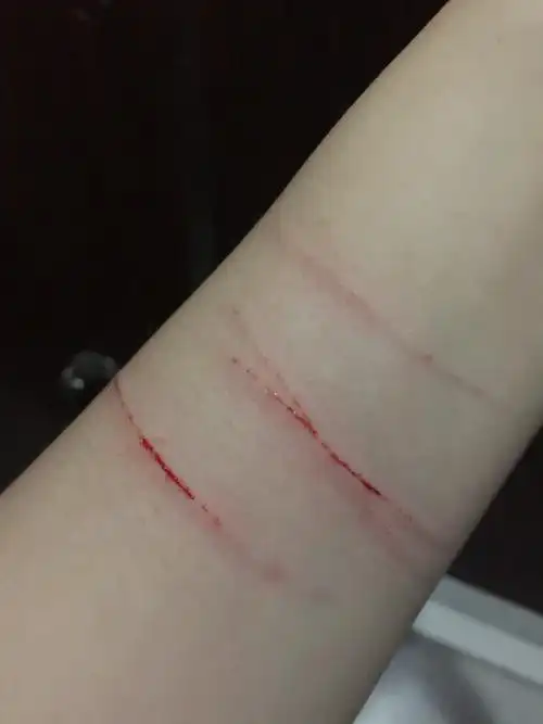 这划伤了,用了双氧水,然后每天都涂点芦荟胶 有点痛痛的.