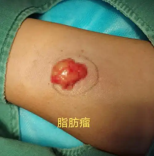 脂肪瘤如何处理