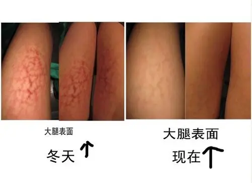 冬天烤电热扇留下的烤火斑,过了夏天还是没有掉,平时涂了芦荟胶,芦荟